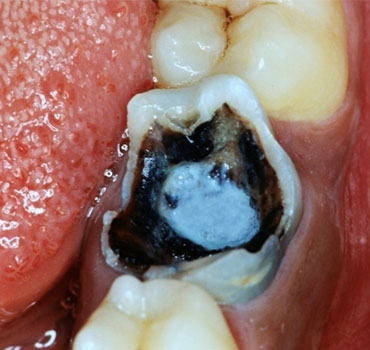 Dente com extensa lesão de cárie, com indicação de exodontia.