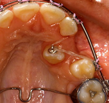Tracionamento ortodôntico de canino superior esquerdo