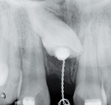 Radiografia mostrando aparato ortodôntico instalado em incisivo superior incluso para tracionamento 