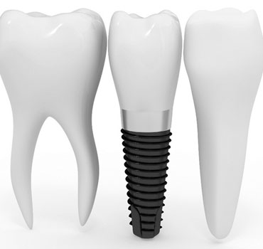 Desenho ilustrando um implante dentário com prótese unitária, instalado em mandíbula