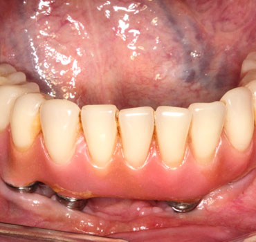 Prótese dentária total inferior fixa sobre implantes instalados na mandíbula