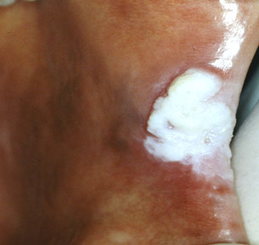 Leucoplasia de mucosa jugal e comissura labial