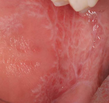 Líquen plano em mucosa jugal