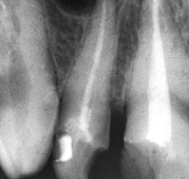 Radiografia mostrando cisto periapical inflamatório associado ao incisivo lateral superior direito