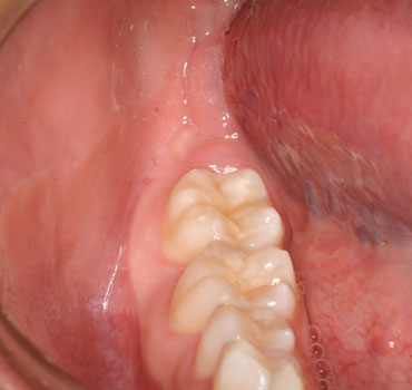Imagens clínica e tomográfica  de um tumor odontogênico queratocístico (ceratocisto) em região posterior de mandíbula
