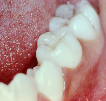 Segundo molar decíduo inferior esquerdo anquilosado interferindo na erupção do segundo pré-molar inferior esquerdo