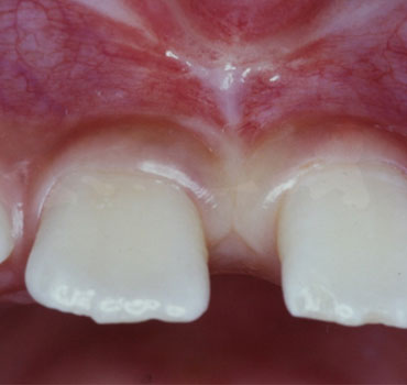 Freio labial superior com indicação de frenectomia. Antes e após  a cirurgia