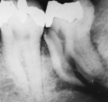 Radiografia mostrando dente com fratura longitudinal, com indicação de exodontia.