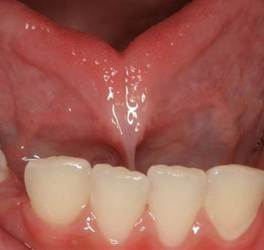 Anquiloglossia com indicação de frenectomia lingual