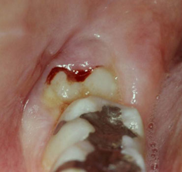 Pericoronarite associada ao terceiro molar inferior direito semi-incluso