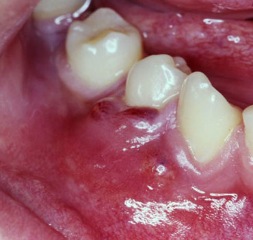 Abscesso gengival associado ao primeiro pré-molar inferior direito