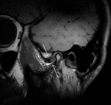  Exame de ressonância magnética mostrando a ATM  com deslocamento anterior do disco articular degenerado (boca fechada) e a falha na recaptura do disco (boca aberta)