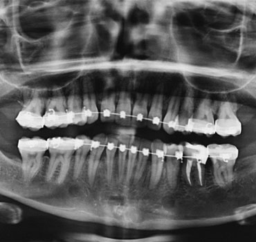 Radiografia mostrando hiperplasia condilar na ATM esquerda