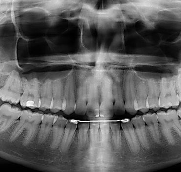  Radiografia mostrando processo de reabsorção condilar bilateral