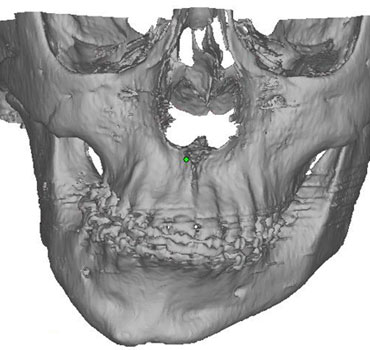 Tomografia computadorizada com reconstrução 3D de um paciente com severa deformidade dento-esquelética associada à anquilose óssea da ATM direita