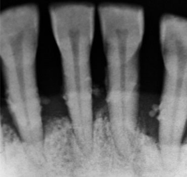 Radiografia mostrando dentes associados a doença periodontal avançada, com indicação de exodontia.