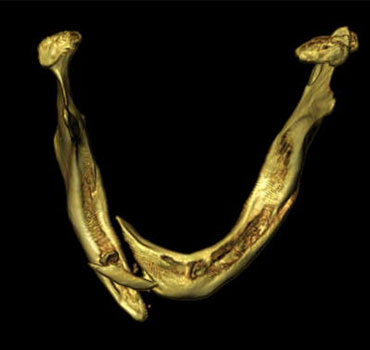 Tomografia computadorizada com reconstrução 3D de um paciente edentado, apresentando fraturas mandibulares