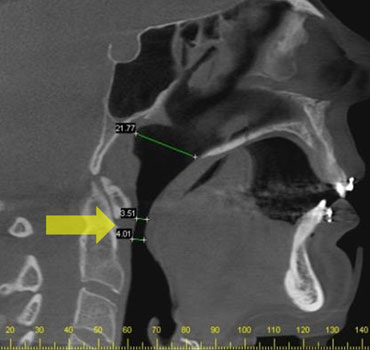 Tomografia computadorizada mostrando o estreitamento das vias aéreas em um paciente com Síndrome da Apnéia Obstrutiva do Sono