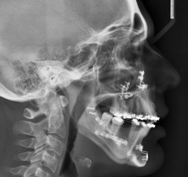 Radiografia de um paciente tratado da Síndrome da Apneia Obstrutiva do Sono, através de cirurgia ortognática 