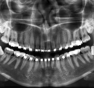 Radiografia mostrando terceiros molares (sisos) superiores e inferiores com indicação  ortodôntica de exodontia