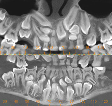 Tomografia mostrando a presença de inúmeros dentes inclusos na maxila e mandíbula