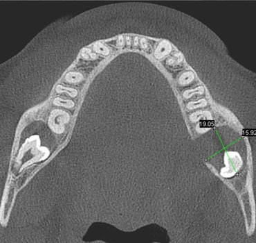 Tomografia mostrando terceiros molares (sisos) inferiores associados a tumores odontogênicos, com indicação de exodontia
