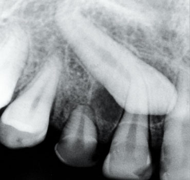 Radiografia mostrando canino superior direito incluso com indicação de tracionamento ortodôntico