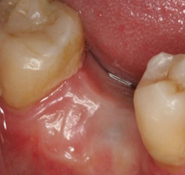 Implante dentário com prótese unitária, instalado em mandíbula na posição do primeiro molar inferior direito