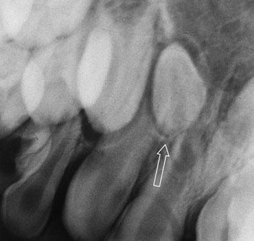 Dentes supra-numerários em região anterior da maxila com indicação de exodontia