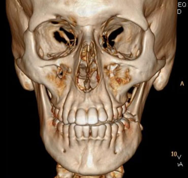 Tomografia computadorizada com reconstrução 3D de um paciente apresentando fraturas mandibulares