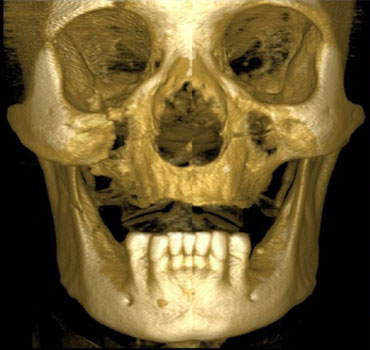 Tomografia computadorizada com reconstrução 3D de um paciente apresentando fraturas do osso zigomático e mandíbula